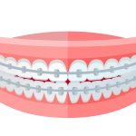 Menggunakan Kawat Gigi? Kenali Bahaya Penggunaannya