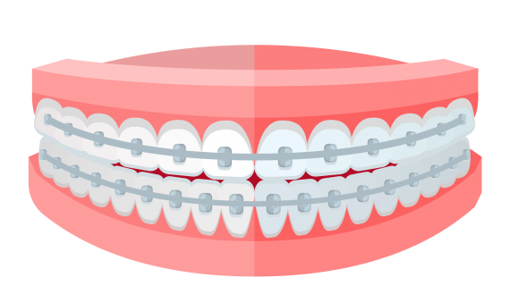 Menggunakan Kawat Gigi? Kenali Bahaya Penggunaannya